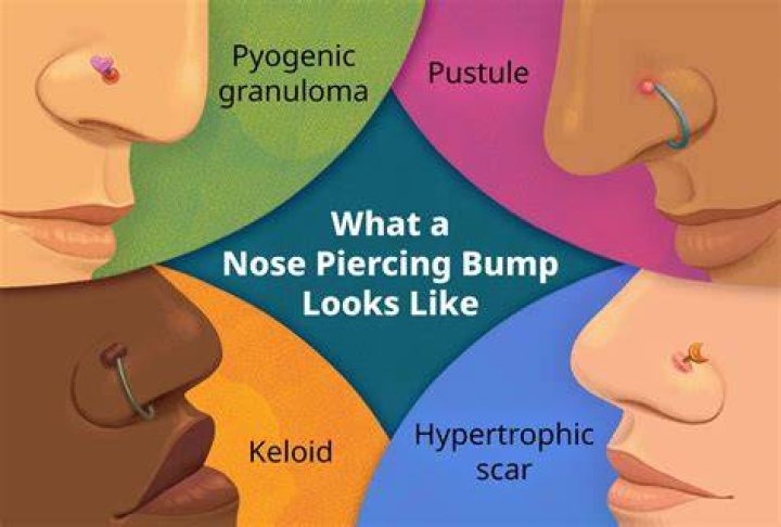 Can a nose piercing fall out?