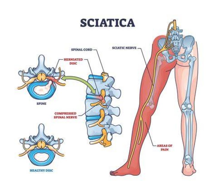 Can cervical spine cause sciatica?