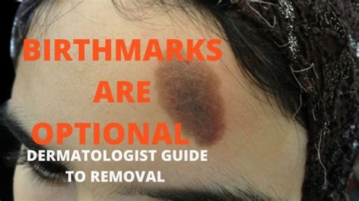 How do I get rid of birthmarks on my head?