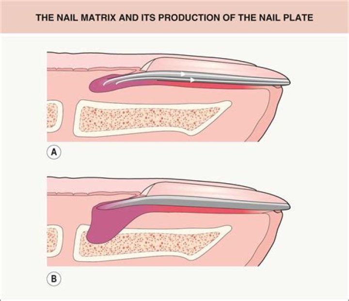 How do you remove a nail that is stuck in between your teeth?