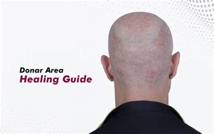 How long does the donor area take to heal?