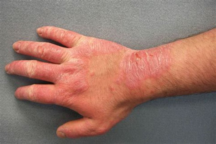 What causes itchy hands and feet with no rash?