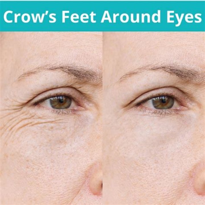 What filler is best for crows feet?