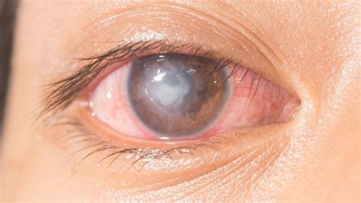 What is an ulcus?