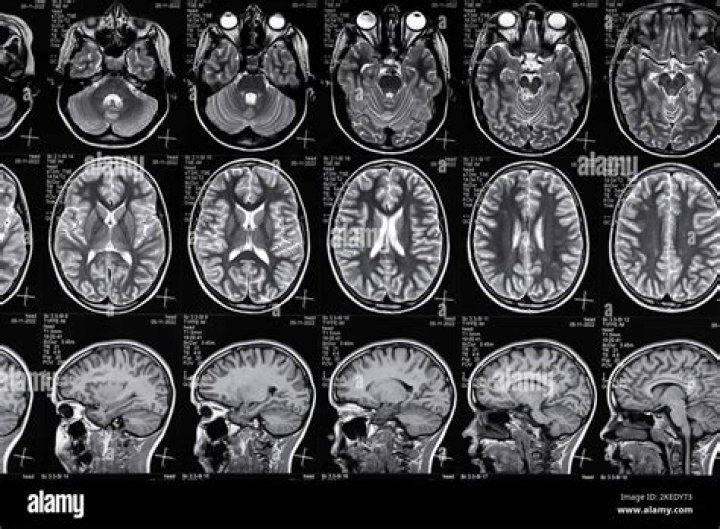 What is MRI EPI?