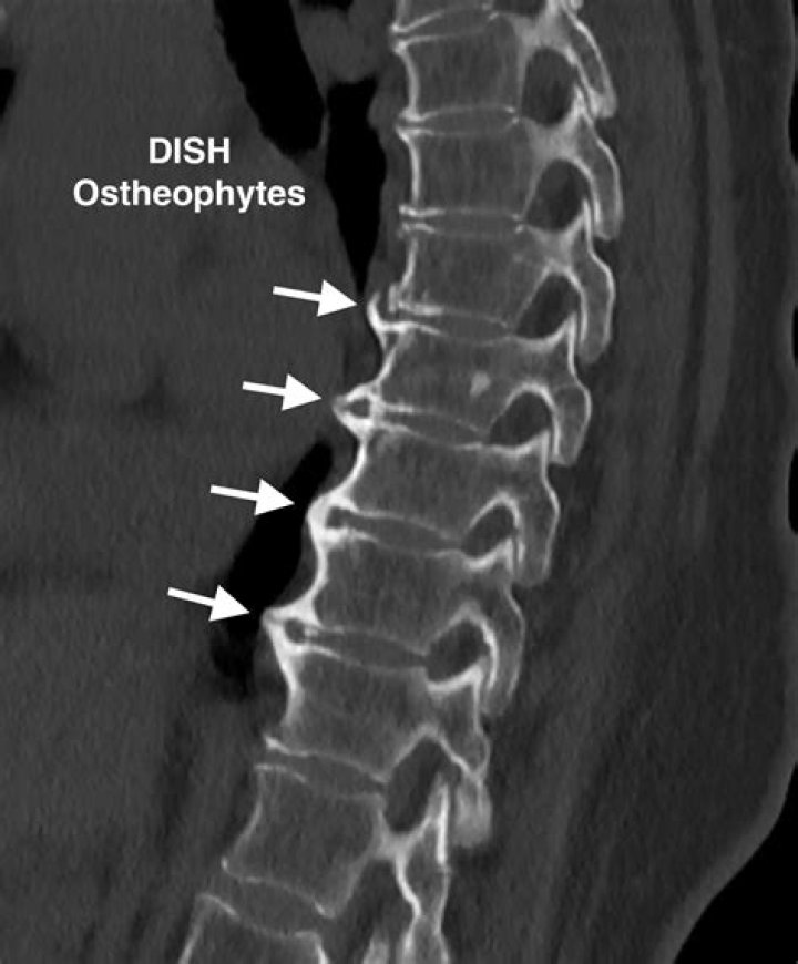 What is the dish in parasite?