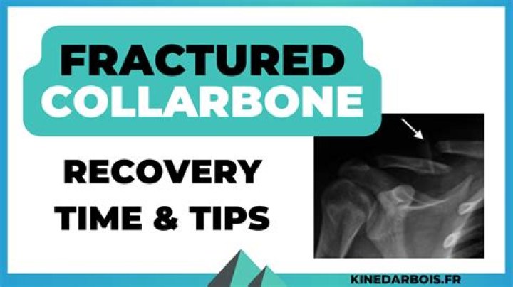 When can I cycle after broken collarbone?