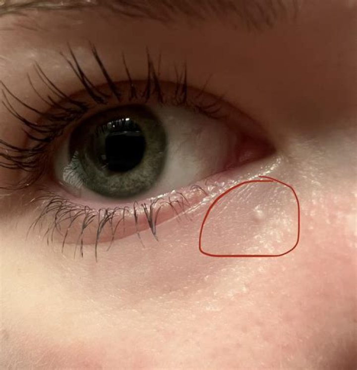 Why is there a white spot on my pupil?